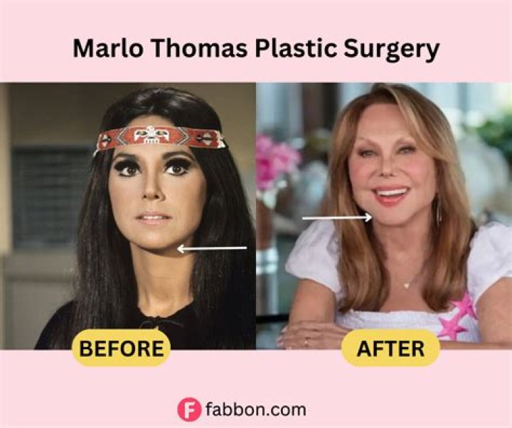 Did Marlo Thomas Undergo Face Surgery? Before And After Photos On IG